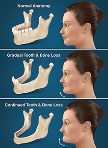 Full Arch Dental Implants Murrells Inlet